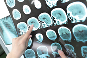 More studies needed on the effect of risk factors on multiple sclerosis