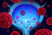 Photodynamic therapy may effectively treat bladder cancer
