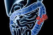 BMI is a risk factor for colorectal cancer death