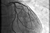 Common fluids no better than saline for preventing kidney injury during angiograms