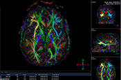 White matter damage could explain chronic headaches after TBI