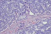 Biopsy pattern can predict lethality of prostate cancer
