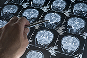 Traumatic brain injury may increase brain cancer risk