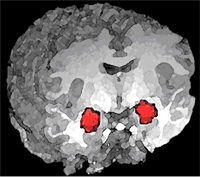 In this 3-D MRI image, the amygdala is shown in red. Researchers with VA and Duke University have linked the brain area to PTSD. 