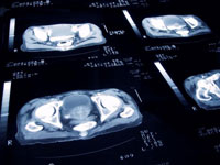  An enlarged cancerous prostate is shown on a CT scan. As part of a large NIH-sponsored study, VA researchers and colleagues have reported the 15-year follow-up results on more than 1,600 men treated for the disease. (Photo: iStockphoto) 