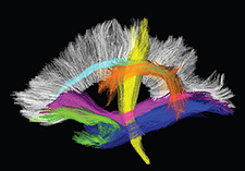 Diffusion MRI images such as these can reveal subtle white-matter damage in the brain. 