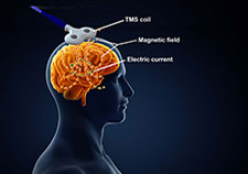 Transcranial magnetic stimulation uses a magnetic coil to induce an electrical current in brain cells. (Illustration: iStock/cosmin4000 and Robert Williams)  