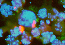 Bladder cancer cells in the throes of apoptosis, or cell death, after an experimental treatment. 