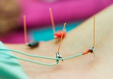  Electroacupuncture uses the same points on the body as traditional acupuncture but relies on small electrical currents, in addition to the needles themselves, for stimulation.
 