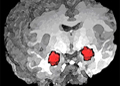 In this 3-D MRI image, the amygdala is shown in red. Researchers with VA and Duke University have linked the brain area to PTSD.  
