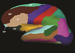 The graphic shows the brain regions that were examined in Dr. Linda Chao's MRI study of Gulf War Veterans and the link between their sleep quality and
    brain volume.