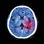 Drug shows promise in reducing deadly brain swelling after stroke 