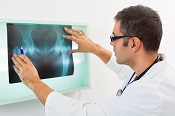 Tryptophan may protect against hip fractures - Photo: ©iStock/fotostorm