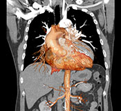Understanding a cause of aortic aneurysm - Illustration: ©iStock/mr.suphachai praserdumrongchai