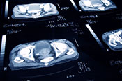 Apalutamide could delay metastasis of prostate cancer - Photo: ©iStock/jamesbenet