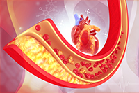 Stiffening arteries linked to Alzheimer’s disease