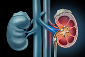 Process behind kidney stone formation - Image: ©iStock/wildpixel