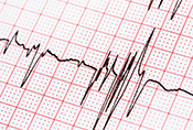 Prescription opioids may increase risk of atrial fibrillation