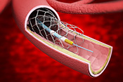 Elective percutaneous coronary interventions in VA largely appropriate - Photo: iStock/adventtr