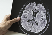 Neurobehavioral therapy proven to help seizure patients