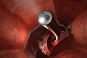 Abnormal Stool Test Result? Don't Delay Your Colonoscopy