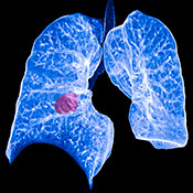 Artificial intelligence diagnoses lung cancer