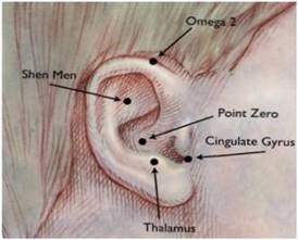 The five ear points used in battlefield acupuncture. (Illustration courtesy of Niemtzow, et al.)  