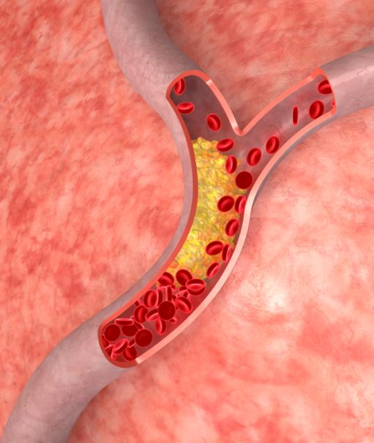 VA research shows statins may contribute to calcium deposits in arterial plaques, which also contain cholesterol. Some research suggests the calcium may actually help by stabilizing the plaques, but this theory is still being investigated.