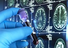 Head trauma, PTSD may increase genetic variant's impact on Alzheimer's risk