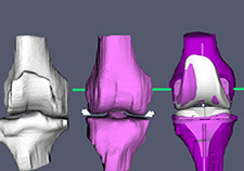 Study: More pain relief with new knee replacement method 
