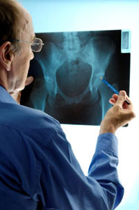 A physician examines a hip bone X-ray. Researchers say high levels of a protein called cystatin C may signal greater risk for hip fracture in older people. (Photo: iStockphoto)