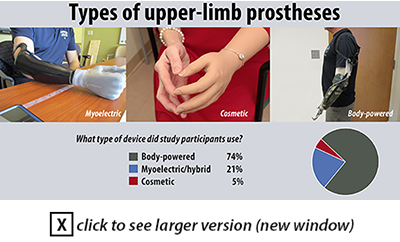 Study probes user satisfaction with upper-limb prostheses