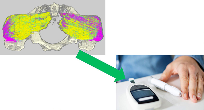 IThe PIPChip device is under development to identify blood-based biomarkers for pressure injury risk in people living with SCIs. (Photo courtesy Congressionally Directed Medical Research Programs and Dr. Kath Bogie.) 