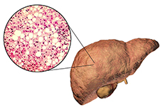 MVP study offers new insights on genetic risk for non-alcoholic fatty liver disease