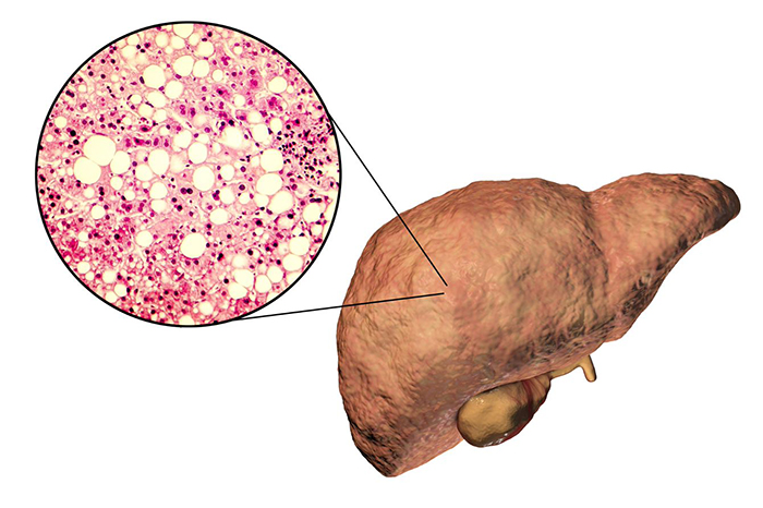  VA MVP researchers identified genetic risk factors for non-alcoholic fatty liver disease, a condition that can cause liver cancer and cirrhosis. (Image for illustrative purposes only. Â©Getty Images/Dr_Microbe)