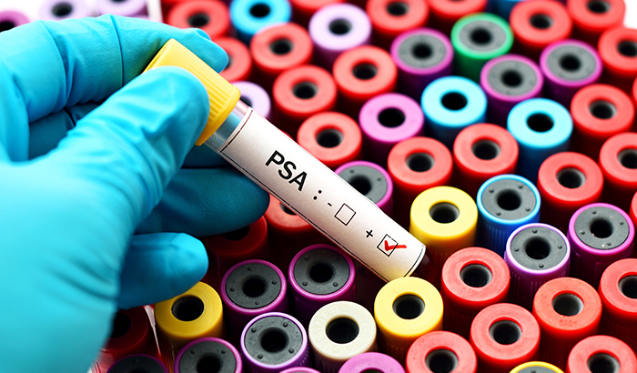 The observation approach to treating prostate cancer involves regular monitoring using the PSA (prostate specific antigen) blood test and delayed surgery to reduce symptoms if they develop. 