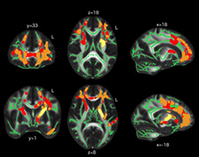 Brain scans that were part of a 2015 TRACTS study documented that blast exposure may lead to change in brain structure even in the absence of outward concussion symptoms. 