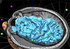 A San Diego VA team used MRI images and special software to coordinate the precise targeting of magnetic stimulation into the target brain area.   