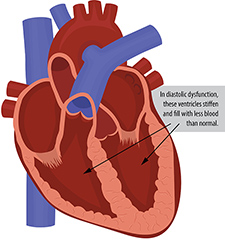 Diastolic function 
