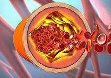 MVP study on cholesterol genetics could lead to new treatments for heart disease, diabetes