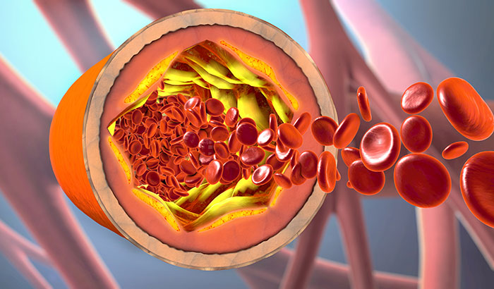  New research based on VA’s Million Veteran Program has identified genetic mutations that govern cholesterol levels. High levels of cholesterol in the blood can narrow arteries and increase the risk of a heart attack or stroke. (Illustration: ©iStock/man_at_mouse) 