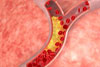 VA research shows statins may contribute to calcium deposits in arterial plaques, which also contain cholesterol. Some research suggests the calcium may actually help by stabilizing the plaques, but this theory is still being investigated. 