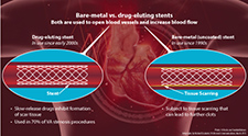  Bare-metal vs. drug-eluting stents 