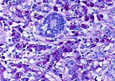  A lab image of a stomach tumor. 
