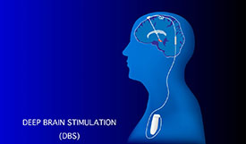 Deep Brain Stimulation