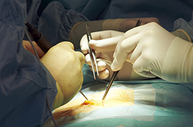 Treating inguinal hernias