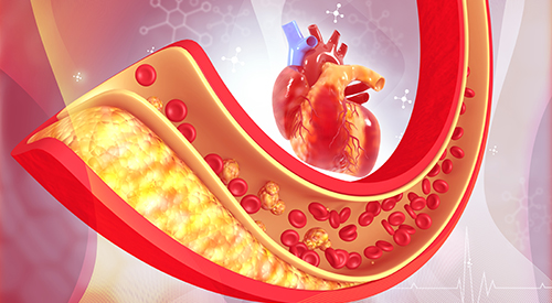 Artery Stiffness Linked to Alzheimer’s