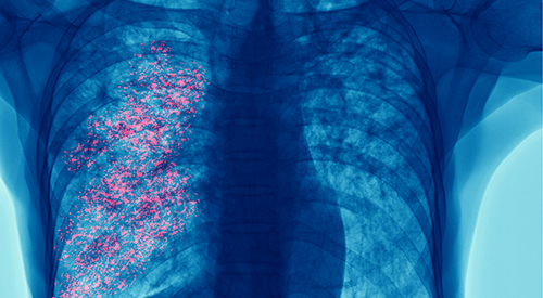 Interstitial Lung Disease