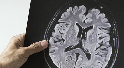 Neurobehavioral therapy helps with seizures