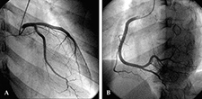 Images show the left and right coronary arteries, as seen during an angiogram. 